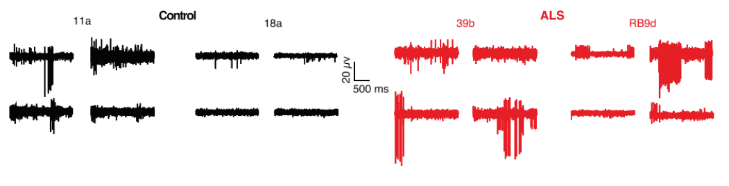 Neural activity recorded on patch clamp from iPSC-derived ALS neurons with SOD1 A4V/+ mutation