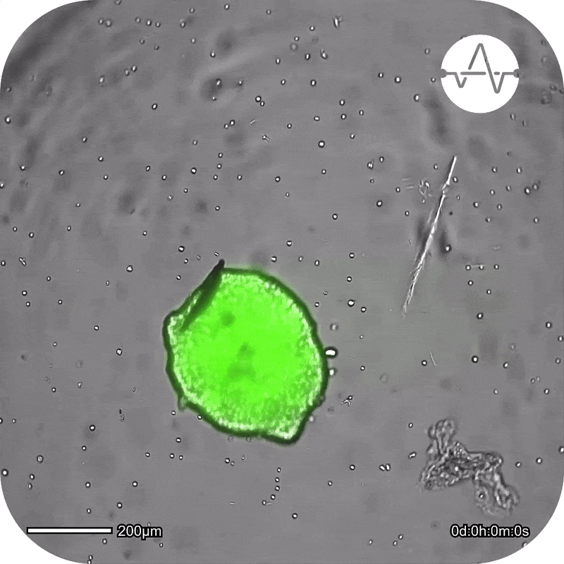 Live-cell imaging data showing CAR T cell-mediated killing of GFP-expressing A549 cancer spheroids in vitro